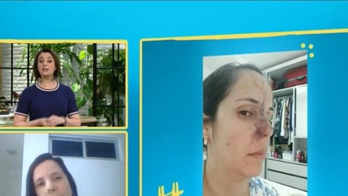 Dentista tem necrose no nariz após rinomodelação mal-sucedida: "É importante se informar"