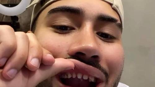 Kevinho diverte a web ao mostrar dentes desgastados para troca de lentes de contato