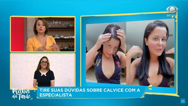 Calvície feminina: especialista tira dúvidas sobre a queda de cabelo em mulheres