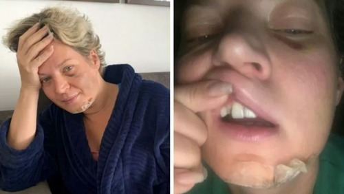 Joice Hasselmann diz que acordou com fraturas pelo corpo; polícia legislativa investiga