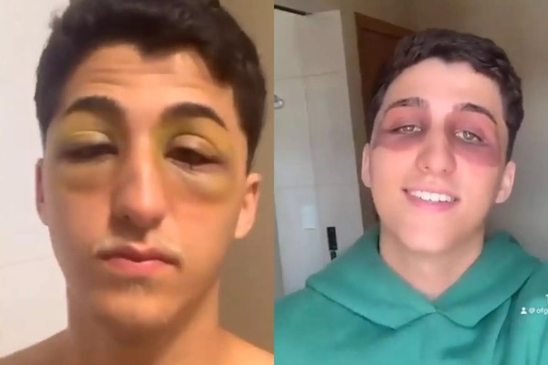 Jovem acorda com olhos inchados sem explicação e intriga web