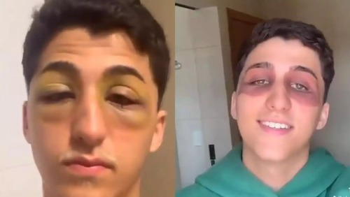 Jovem acorda com olhos inchados sem explicação e intriga web