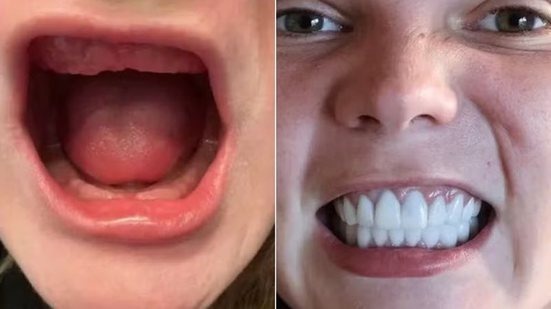 Mulher perde todos os dentes após economizar em tratamento dentário na Turquia