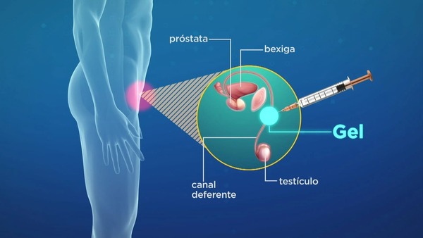 Estudos apontam que gel injetável pode ser eficaz como anticoncepcional masculino