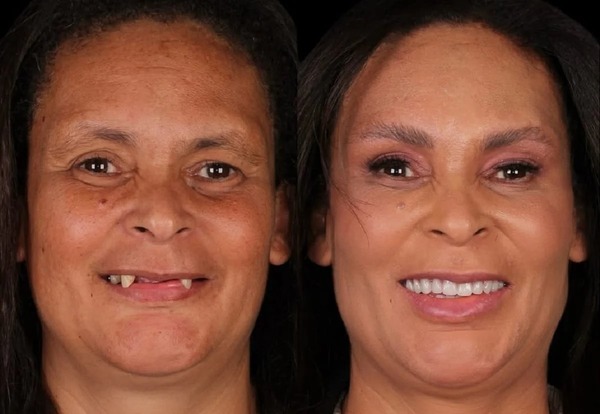 Após anos sem dentes, sogra se emociona com transformação; veja antes e depois