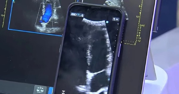 Ultrassom no celular? Aparelhos portáteis podem ajudar médicos em diagnóstico mais rápido