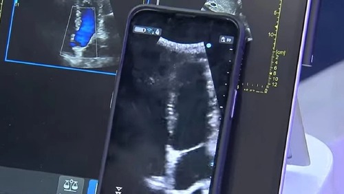 Ultrassom no celular? Aparelhos portáteis podem ajudar médicos em diagnóstico mais rápido