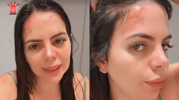 Ex-Casamento às Cegas, Renata Giaffredo sofre queimaduras após acidente com panela de pressão