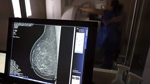 Câncer de mama: uma em cada três pacientes tem menos de 50 anos