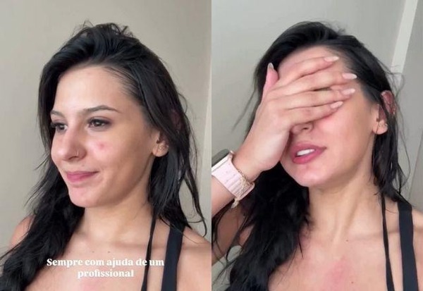Ana Castela muda os hábitos e desabafa sobre condição da pele