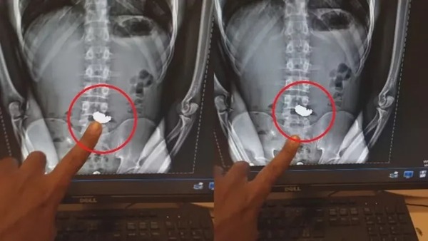 Vítima de assalto aguarda bandido expelir corrente de ouro de 20 mil reais roubada
