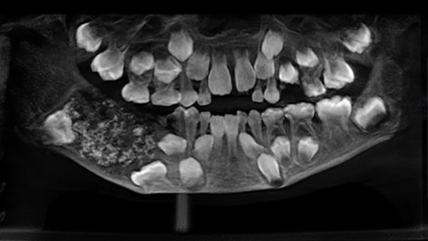 Menino de 7 anos tem 526 dentes retirados em cirurgia na Índia