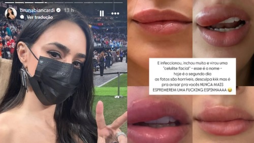 Bruna Biancardi revela tratamento contra celulite facial; entenda condição