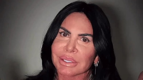 Gretchen choca fãs e revela sofrer de doença que deixa careca: "não tenho mais cabelo"