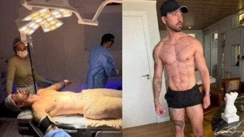 Rico Melquiades passa por 15ª cirurgia plástica
