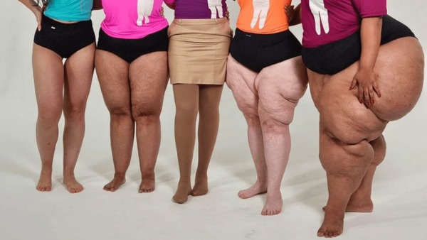 Estudo brasileiro facilita diagnóstico de lipedema por ultrassom