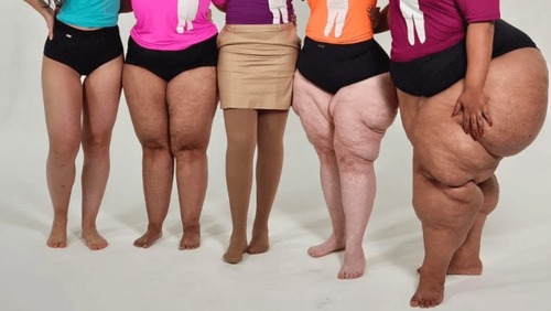 Estudo brasileiro facilita diagnóstico de lipedema por ultrassom