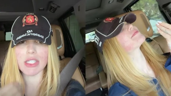 Virginia reclama de procedimento que deixou rosto 'em carne viva'