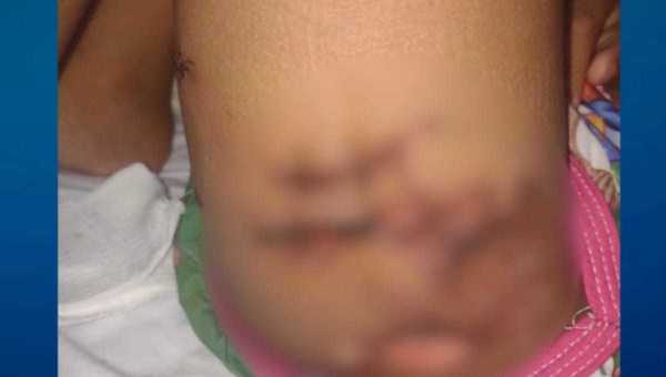 Criança atacada por pitbull tem alta; cão já feriu outras três pessoas em Campinas