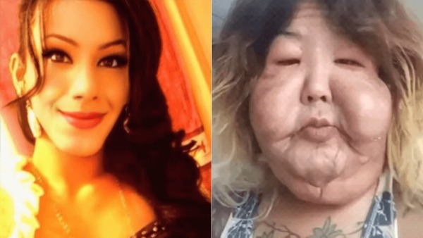 Juju do Pix faz cirurgia para retirar óleo mineral do rosto; veja resultado