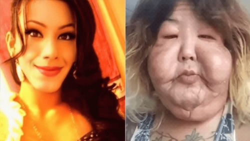 Juju do Pix faz cirurgia para retirar óleo mineral do rosto; veja resultado