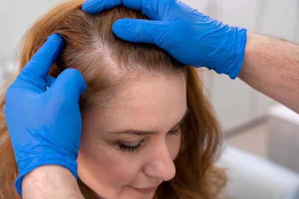 Alopecia androgenética afeta cerca de 5% das mulheres no Brasil; entenda