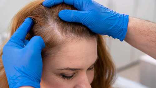 Alopecia androgenética afeta cerca de 5% das mulheres no Brasil; entenda