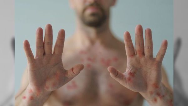 Mpox no Brasil: entenda o que é a doença, os sintomas e como prevenir