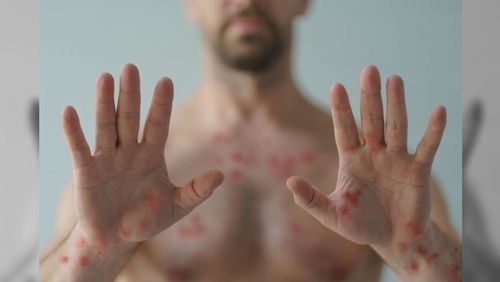 Mpox no Brasil: entenda o que é a doença, os sintomas e como prevenir