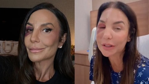 Ivete Sangalo vai cantar no BBB26? Cirurgia da cantora pode ser entrave