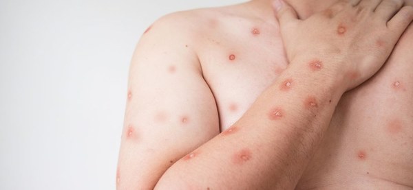 Sobe para 140 número de casos confirmados de Mpox no país, em 2026