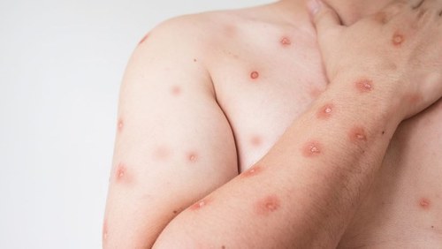 Sobe para 140 número de casos confirmados de Mpox no país, em 2026