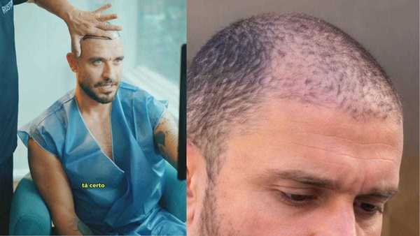 Diogo Nogueira revela novo transplante capilar: “Agora é esperar crescer”