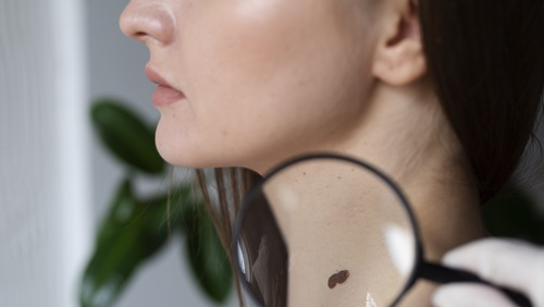 Câncer de pele lidera incidência no Brasil e concentra maior número de casos no estado de São Paulo