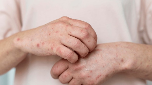 Catapora em adultos: é possível se vacinar? Entenda riscos e prevenção