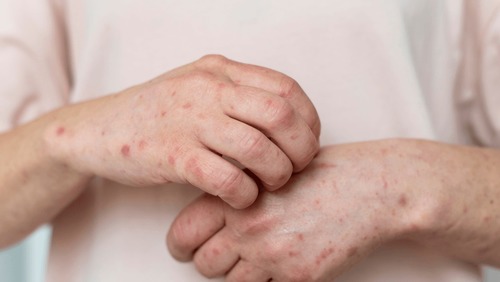 Catapora em adultos: é possível se vacinar? Entenda riscos e prevenção