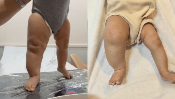 Linfedema: caso de bebê com perna inchada expõe doença comum em adultos