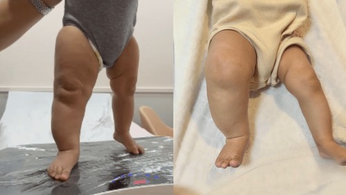 Linfedema: caso de bebê com perna inchada expõe doença comum em adultos