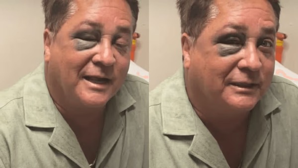 Leonardo sofre acidente em pescaria e aparece com olho roxo; veja fotos