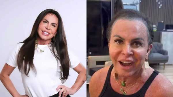 Gretchen aparece sem prótese capilar e detalha tratamento contra alopecia
