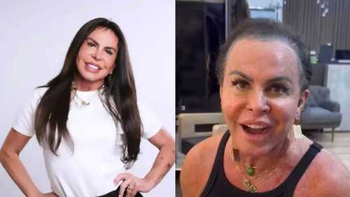 Gretchen aparece sem prótese capilar e detalha tratamento contra alopecia