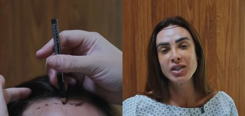 Nicole Bahls faz transplante capilar após alopecia: 'Muito mais feliz'