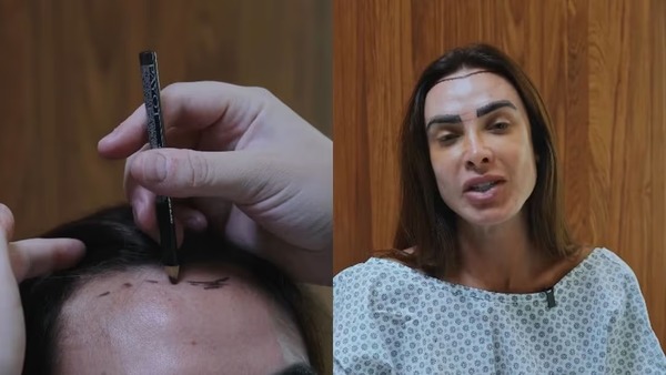 Nicole Bahls faz transplante capilar após alopecia: 'Muito mais feliz'