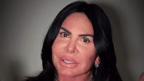 Gretchen desabafa sobre alopecia e diz que vai raspar cabeça: "Tem solução"