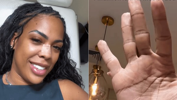Ex-BBB passa por cirurgia para remover "sexto dedo" da mão; veja fotos