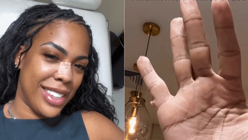 Ex-BBB passa por cirurgia para remover "sexto dedo" da mão; veja fotos
