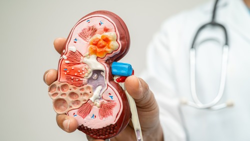 Casos de câncer de rim podem crescer quase 80% no Brasil até 2050 