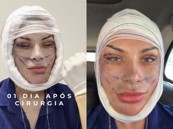 Andressa Urach revela “novo rosto” após gastar R$ 240 mil em cirurgias