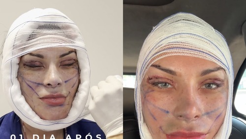 Andressa Urach revela “novo rosto” após gastar R$ 240 mil em cirurgias