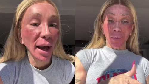 Maya Massafera choca com efeito colateral de peeling: 'Nunca inchou tanto'